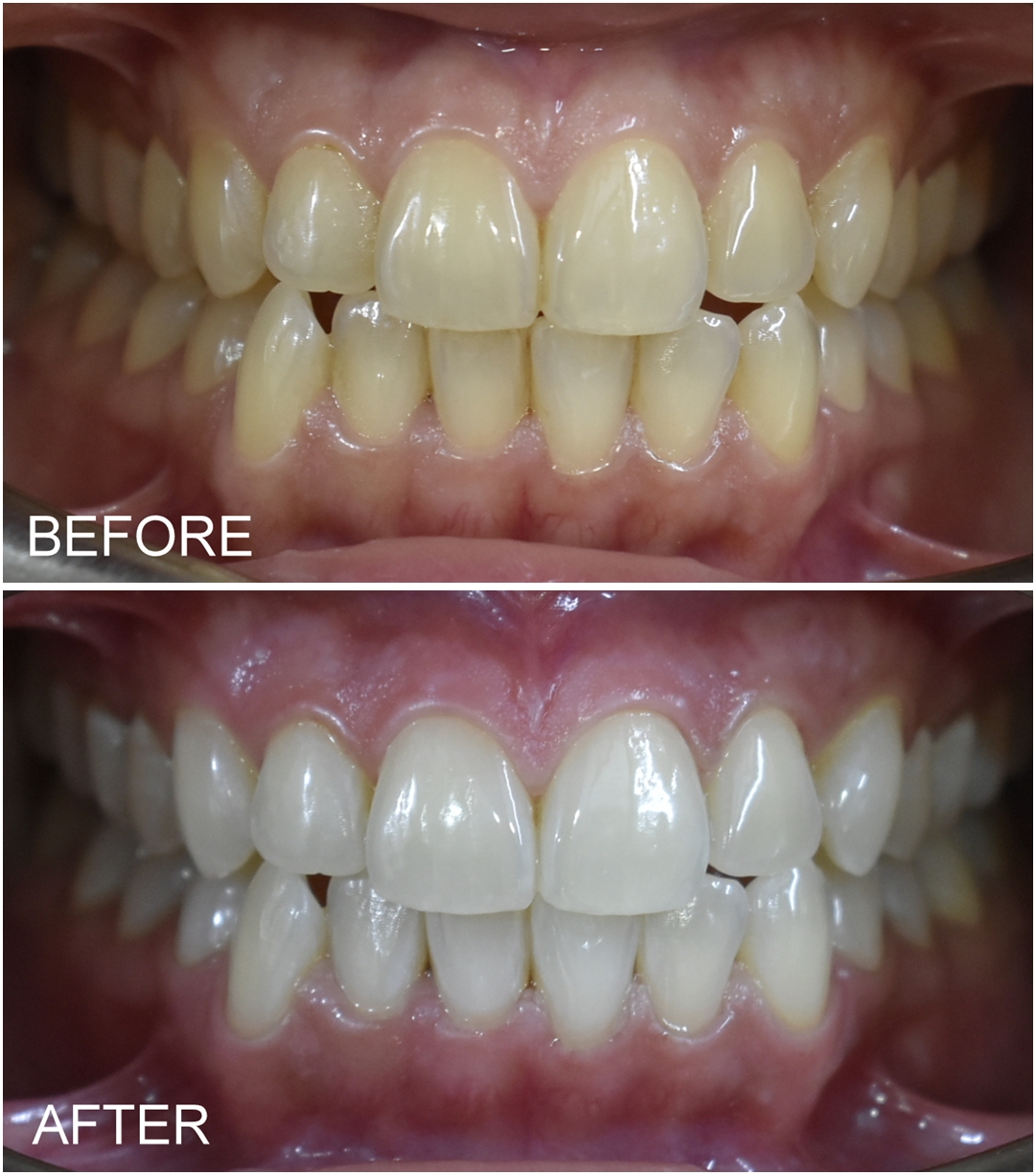 Teeth Whitening