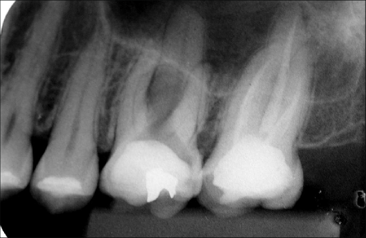 Peri-aprical X-ray