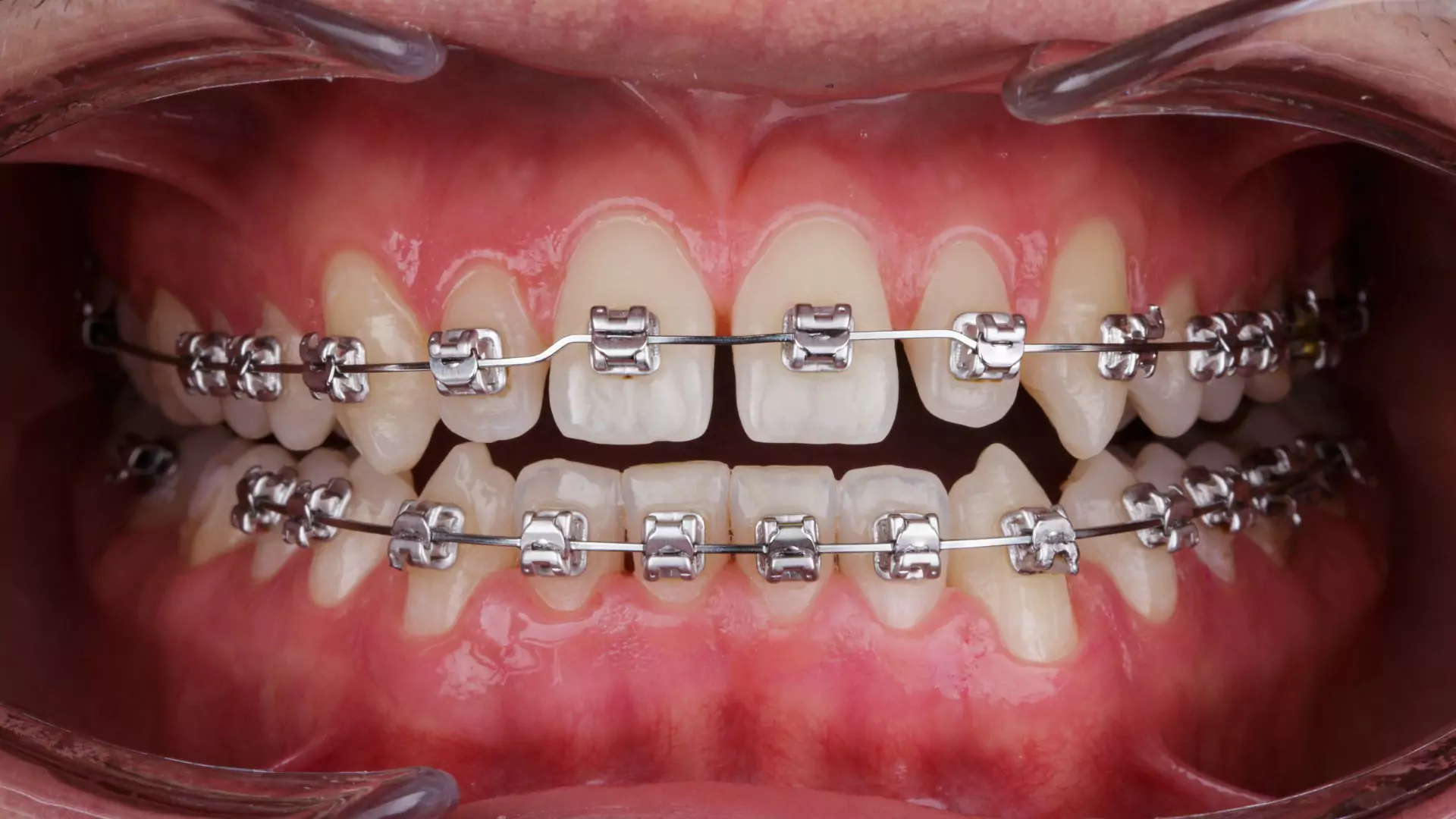 Braces