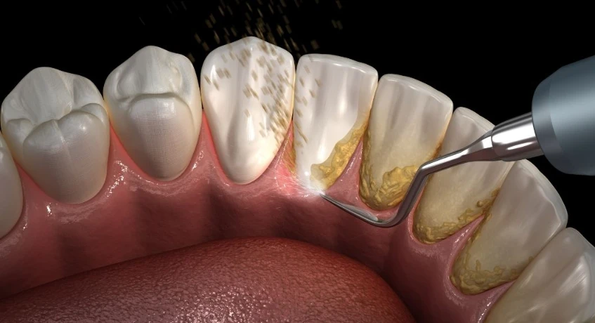 Scaling & Polishing