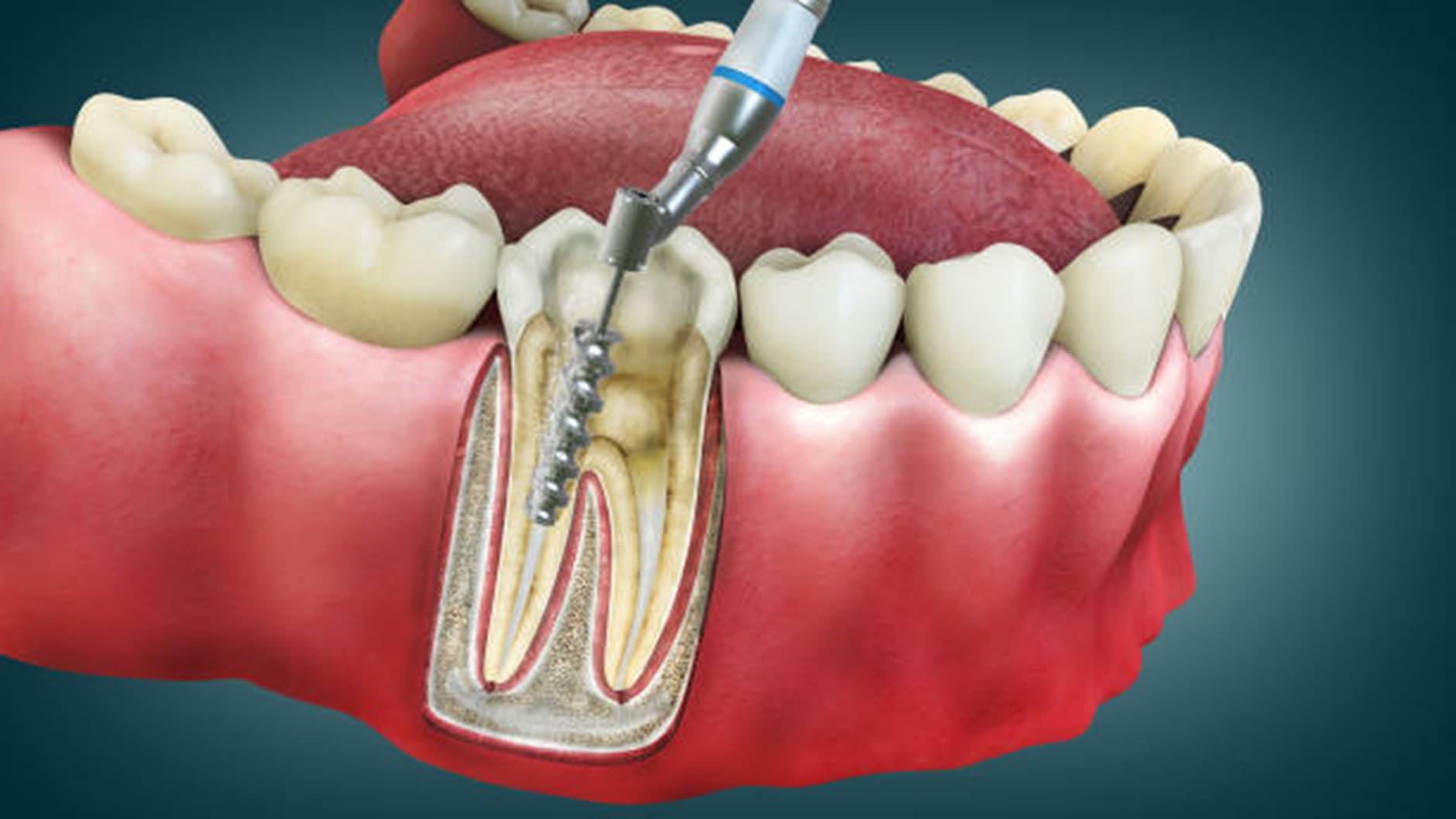 Root Canal Treatment